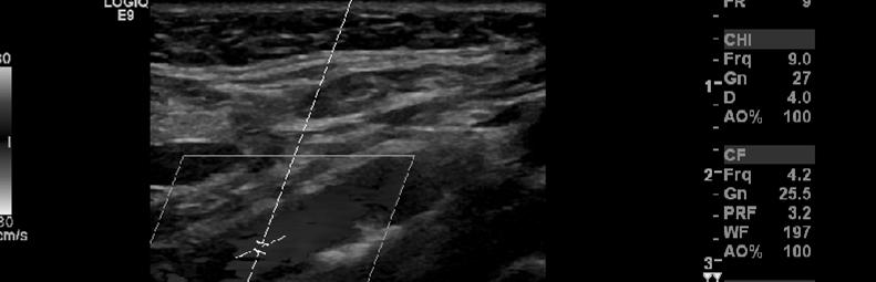 Doppler Ultrasound Dynamic imaging study using frequency shift of returning sound Can detect blood