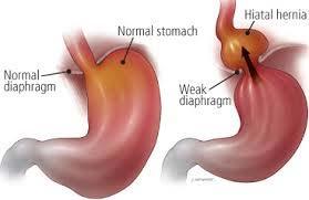 Hiatal Hernia A hiatal hernia occurs when part of your stomach protrudes up through the diaphragm into your chest.