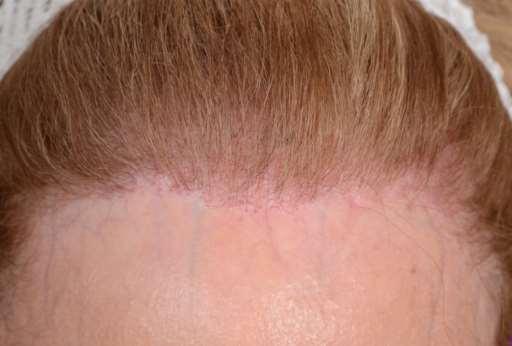 Difficult Clinical Diagnosis Confused with AGA, Alopecia Areata Subtle scarring Inflammation may be