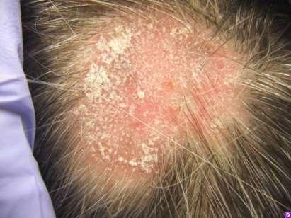 Bacterial and Fungal Culture Pustules Scale Pain Drainage