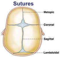 Sutures A suture is a type of fibrous joint which only occurs