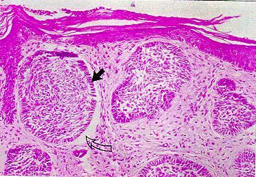 the invasion is very important in these tumors ( BCC and SCC) from the skin surface