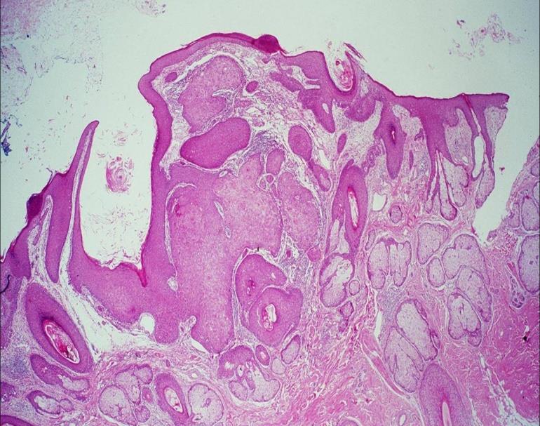 Slide #19 Metastatic tumor at the edge of the nose, there are epitheliomatous boundaries and ulcerated center with subkeratin.