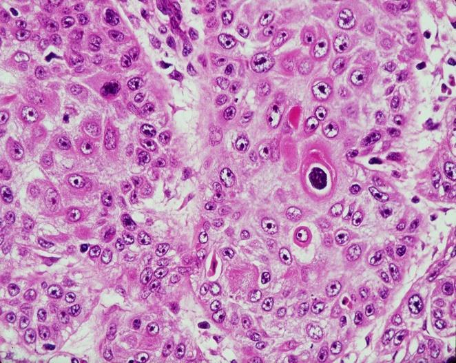 Slide #21 In some tumors according to the degree of differentiation you can suggest that this is a sequamous cell carcinoma like here.