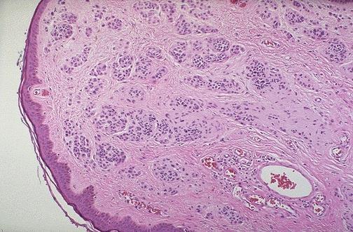 Slide#25 Melanocytic nevus, the Dr just repeated what he explained before Slide #26 This image is not a well illustrative for what the doctor explained "as he said".