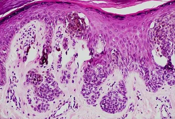 Slide #28 Nests inside the epidermis they are pigmented. Also, they are found In the junctional and dermal components so considered as compound.