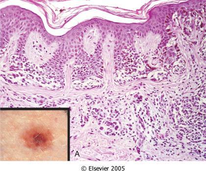 Because melanoma mostly arises de novo and minority of these cases are of dysplastic transformation. The most important feature is atypia in the cells and atypia in the architecture of the junction.