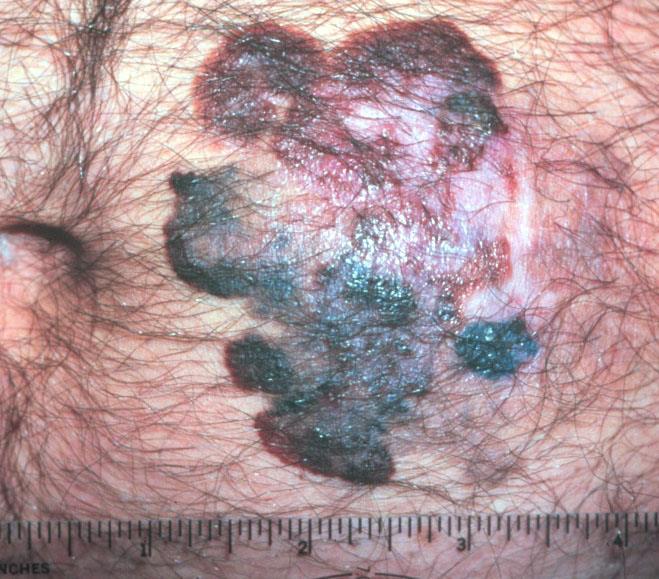 Slide #39 There is a benign nevus in the left side and the other is malignant, notice how irregular in shape is, how variable the pigmentation is.