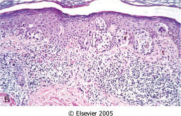 slide #41 Radial growth phase of melanoma, abnormal cells