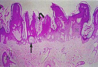 Micro: proliferation of squamous epithelium + cysts filled with keratin * FGFR3 (fibroblast growth factor receptor 3) activating mutation Here notice the well circumscribed