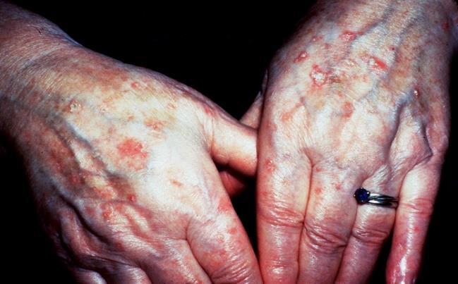 Bowen disease also is a carcinoma in situ means associated with higher risk. Note the plaques with a red discoloration and a hyperkeratotic scale present in the dorsum of the hand.