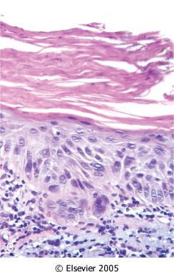 Slide #10 Hyperkeratosis Parakeratosis Dysplas tic CA in Situ There is a para and a hyperkeratosis can be seen especially on the top of the surface, and there is a dysplastic CA in which there is