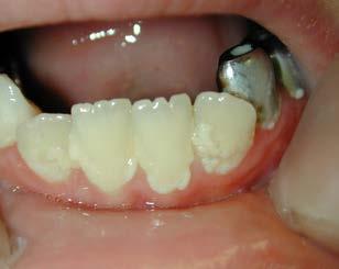 Bacteria within the plaque on the teeth can migrate into the bloodstream and can cause: hardening of the arteries increased risk of blood clots and makes it harder to