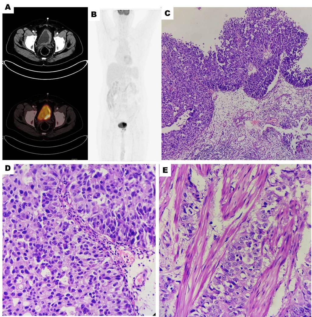 CLL WITH TCC AND PROSTATE CANCER FIG. 2: (A) CT and 18 F FDG PET/CT, Cross section images.