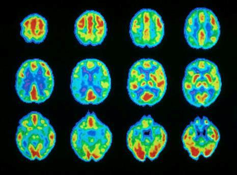 Two Key Risk Factors Age Brain development continues through adolescence.