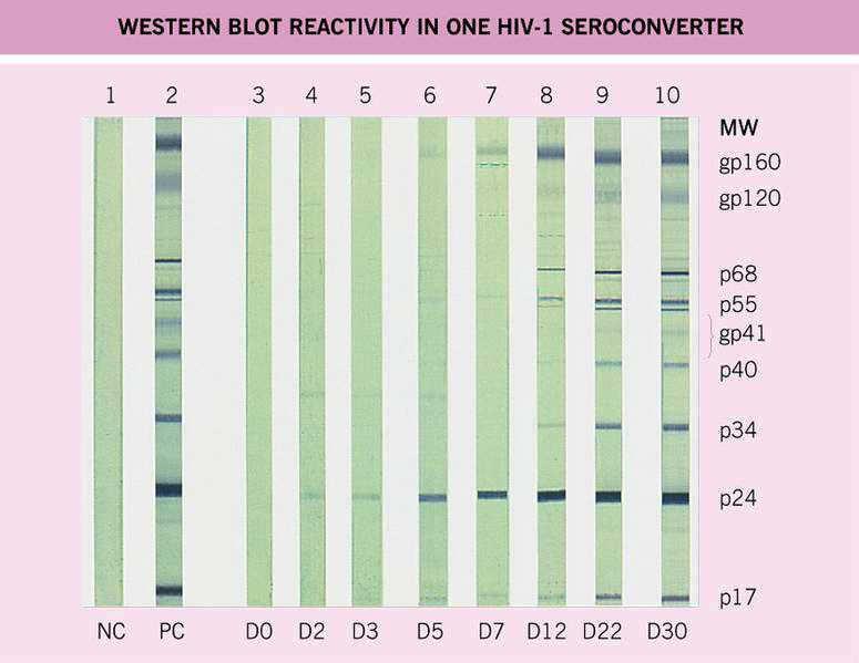 Western Blot Bands Western Blot Criteria for HIV http://www.hivinfosource.org/hivis/files/western_blot.jpg http://www.7mac.com/investigations/hiv_antibody_test_reliability_files/image001.