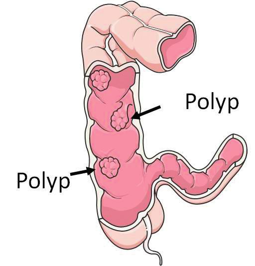 There is no single cause for colon cancer, but nearly all colon cancers begin as non-cancerous polyps.
