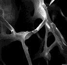 T scores compare BMD to the average individual at peak bone mass Z scores are age matched Scanning electron microscopy of normal and osteoporotic bone Normal Osteoporotic Life-time
