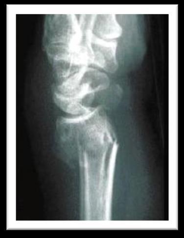 In women with hip fractures: Fracture begets future fracture