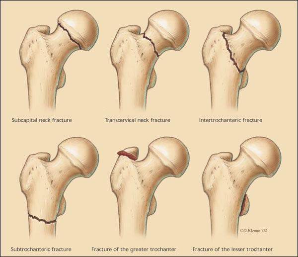 Hip Fractures Subcapital Femoral