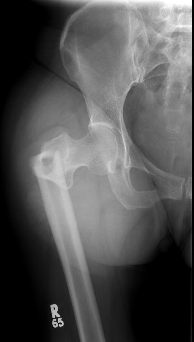 Radiographic Images of AFFs Transverse