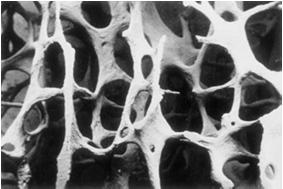 Osteoporosis? A disease characterized by low bone mass and microarchitectural deterioration of bone tissue leading to enhanced bone fragility and a consequent increase in fracture risk.