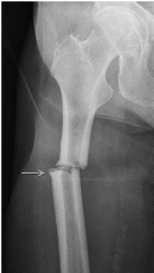Atypical Femoral Fractures (AFF) Hundreds of reports in long-term bisphosphonate users (and others) Transverse not spiral, cortical thickening, minimal trauma Often bilateral, prodromal pain, abn.