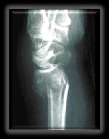 In women with hip fracture: Fracture begets future fracture Deteriorated