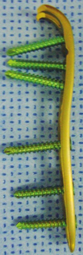 0-mm cortex screws for ulna length adjustment, which potentially can offer good stability and allow early mobilization.