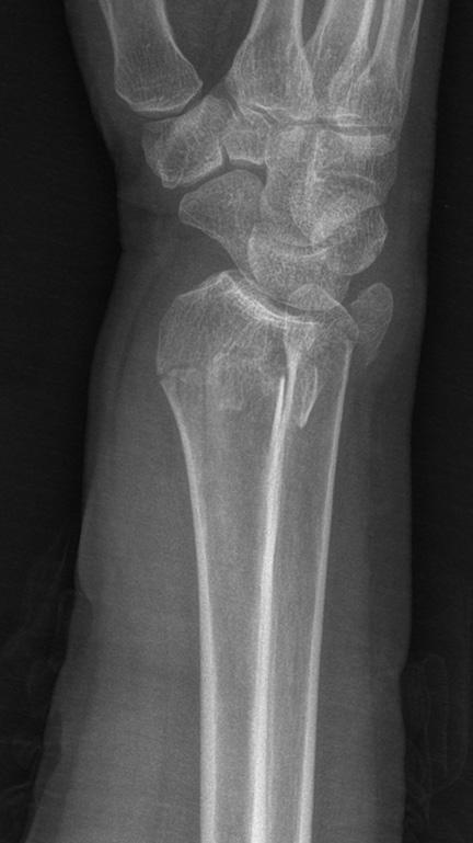 Distal Ulna Hook Plate Fixation Lee et al sured using a JAMAR hand dynamometer (Therapeutic Equipment Corporation, Clayton, New Jersey).