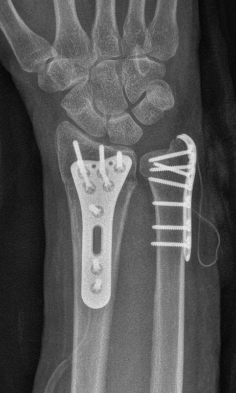 26 Chronic instability of the distal radioulnar joint was assessed by physical examination.