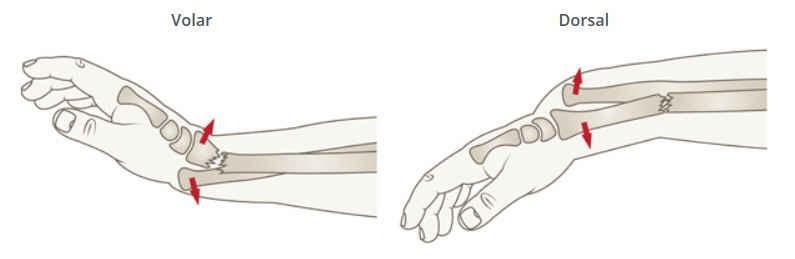 The Galeazzi Equivalent: This is similar to a true Galeazzi with distal third radial fracture accompanied by a