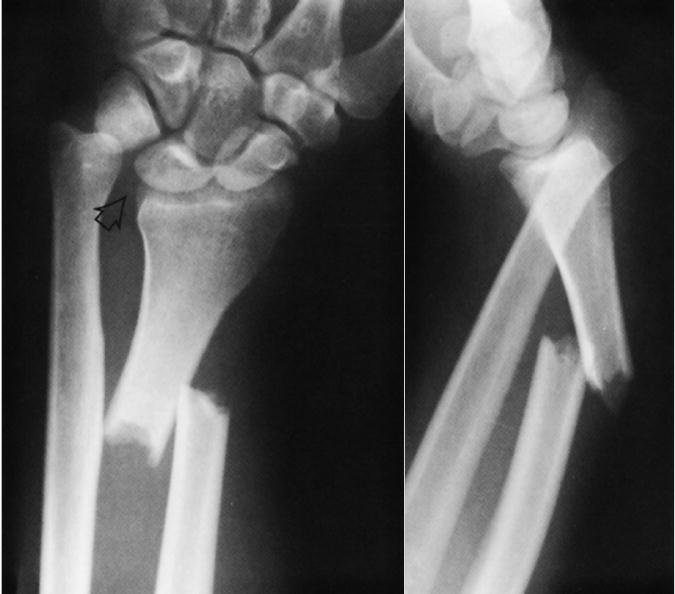 Appendix 1 Left: Galeazzi fracture showing typical radio-ulnar dislocation (volar