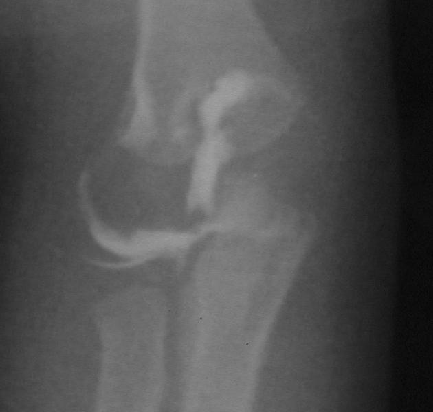 (B) At two weeks there appeared to be some bowing of the ulna and some concern about
