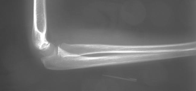 Recently Lincoln and Mubarak (10) have demonstrated that the so-called isolated radial head dislocation is a variant of the Type I lesion because there is almost always subtle evidence of plastic