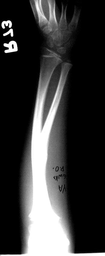 9 sugar tong splint or cast.( Fig. 8 B ). In many cases especially if the child has a small short forearm, it may be difficult to prevent this ulnar bowing with non-operative methods alone.