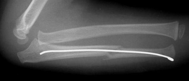 The intramedullary fixation can be achieved either antegrade through the olecranon or retrograde through the distal metaphysis (Fig. 8 C,D ). If the ulna is comminuted plate fixation may be necessary.