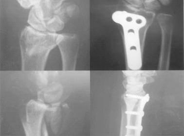 391 Ming-Hsun Dai, et al Fig. 2 A 37-year-old man sustained a left volar Barton s fracture due to a motorcycle accident. The fracture was treated with open reduction and buttress plate fixation.