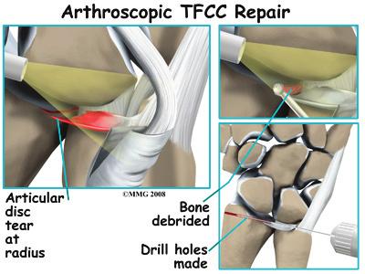 Some ligamentous ruptures with fracture can also be repaired arthroscopically with reattachment and instrumentation.