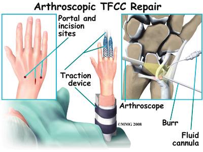 Some surgeons perform an arthroscopic wafer procedure in addition to the TFCC debridement especially when both TFCC disruption and positive