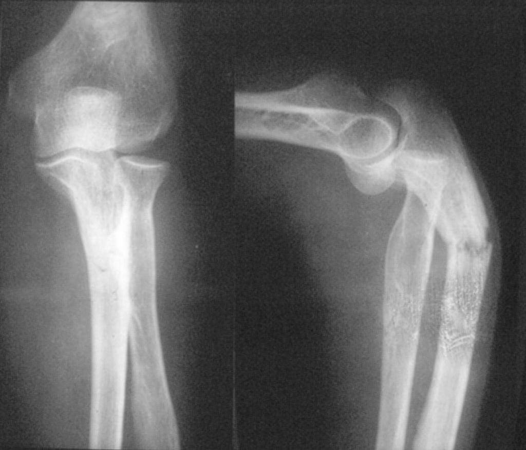 Treatment: Reduction of the ulna.