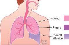 Lungs Shortness of breath Pleural effusion fluid in the space