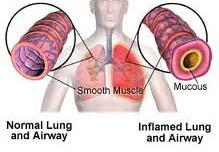 Pneumonitis inflammation of the air sacs of the lung