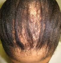 lesions Hair loss