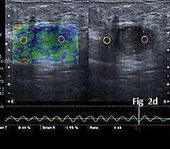 Figure 2d: On elastography lesion showed mosaic pattern with strain ratio of 4.