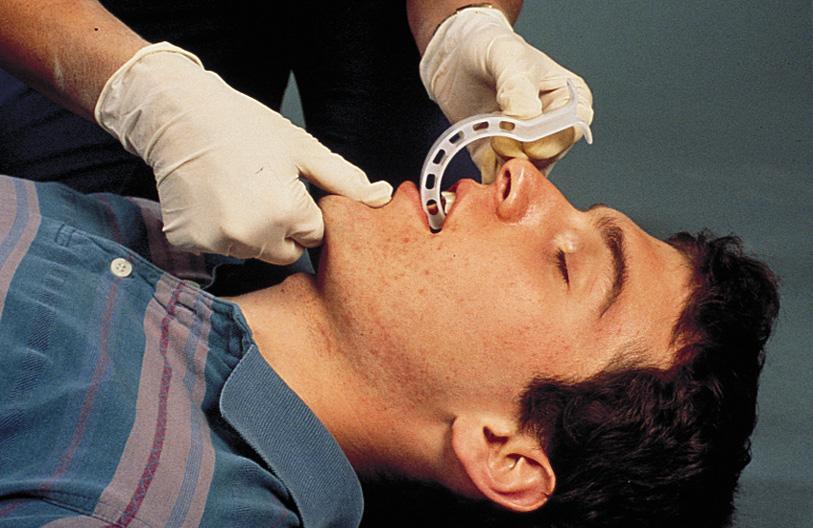 OPA a) In an adult, the airway is inserted with the tip pointing to