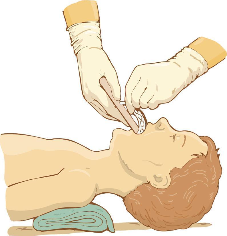 b) In an infant or small child, the airway is inserted with the tip