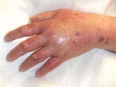 2 cm (1-6 inches) in any direction, cool to touch, with or without pain 3 Skin blanched, translucent, gross edema >15.
