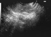 EUS After Chemo/XRT EUS inaccurate for T Staging Fibrotic changes - overstaging