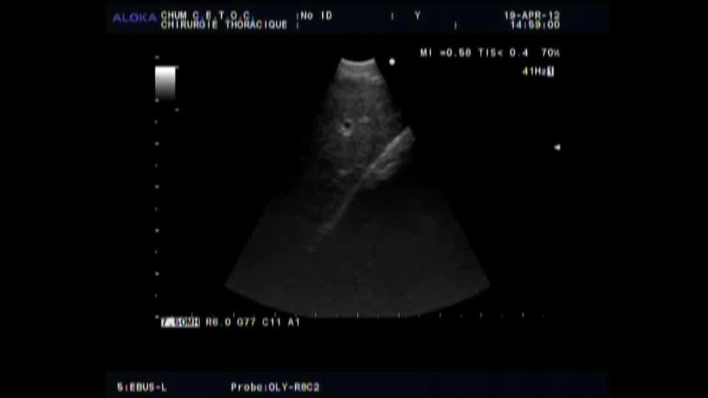 9%) No tumor was dilated prior to EBUS Endobronchial Ultrasound Added to